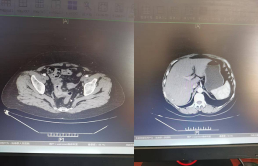 【医疗动态】直肠癌伴肝转移了还有救吗？旌德县人民医院微创同期手术一次根治切除！