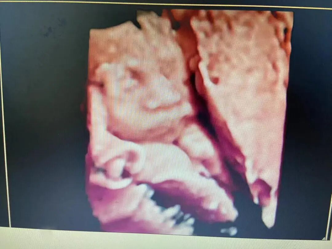 【动态】重视产前筛查，为母婴健康保驾护航